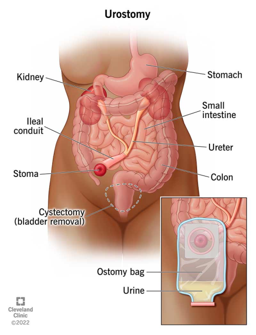 Ileos Recovery: What to Expect and How to Speed It Up