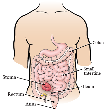 Ileos Recovery: What to Expect and How to Speed It Up