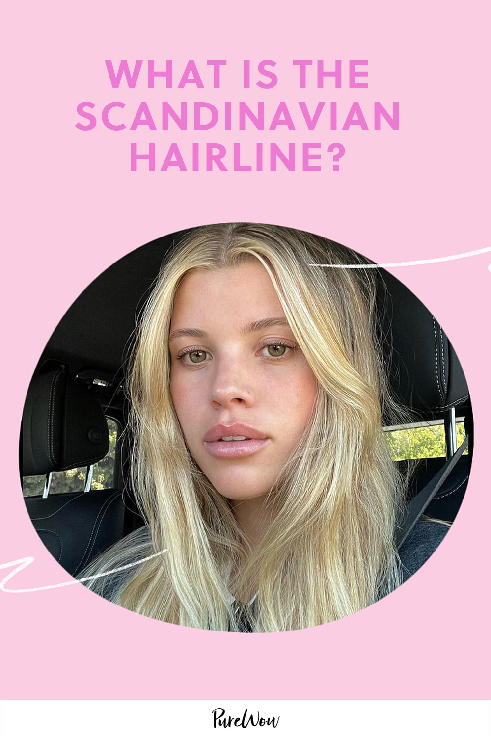 Thinking About a Scandinavian Hairline? Everything You Need to Know