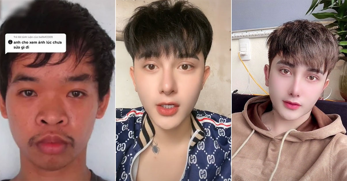 Vietnamese spends plastic surgery: Real stories and shocking results!