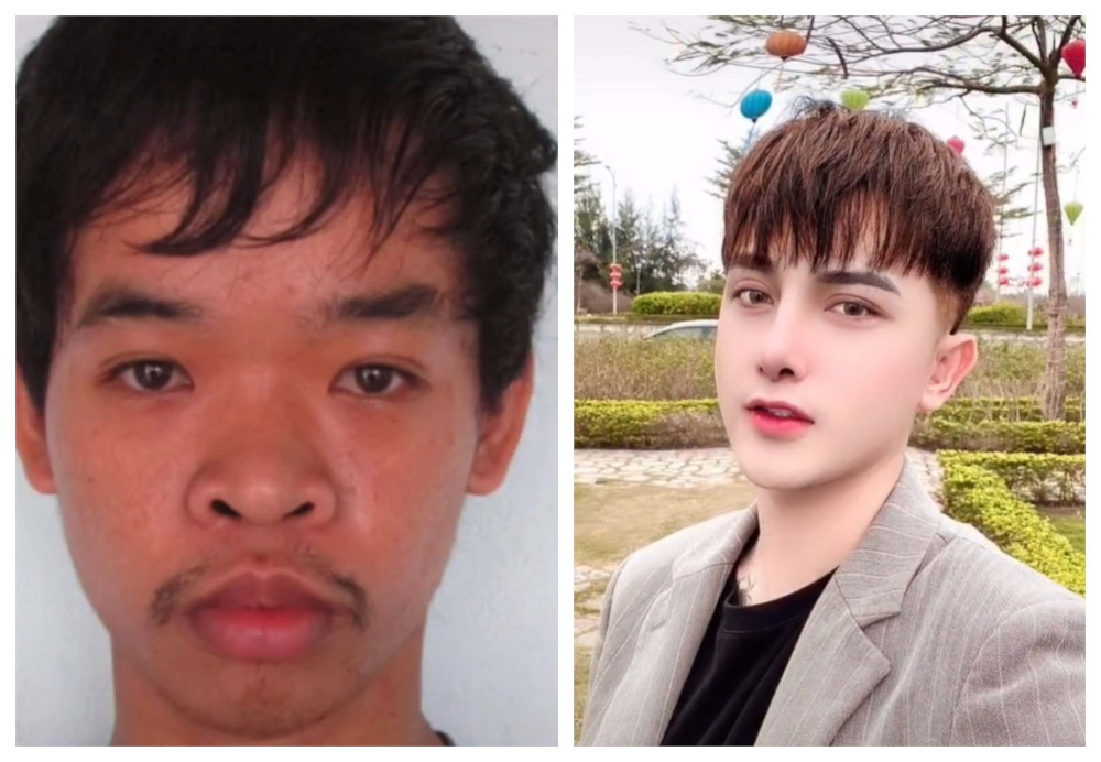 Vietnamese spends plastic surgery: Real stories and shocking results!