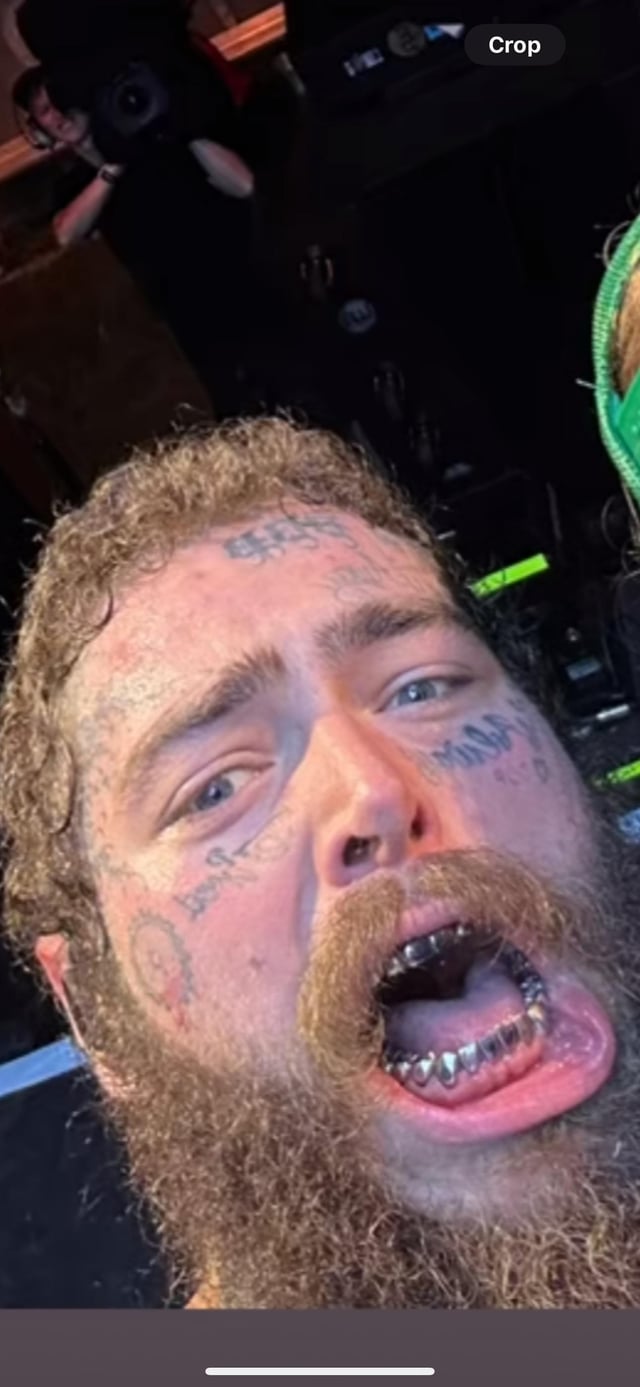 Post Malone Teeth: Before and After the Rappers Smile