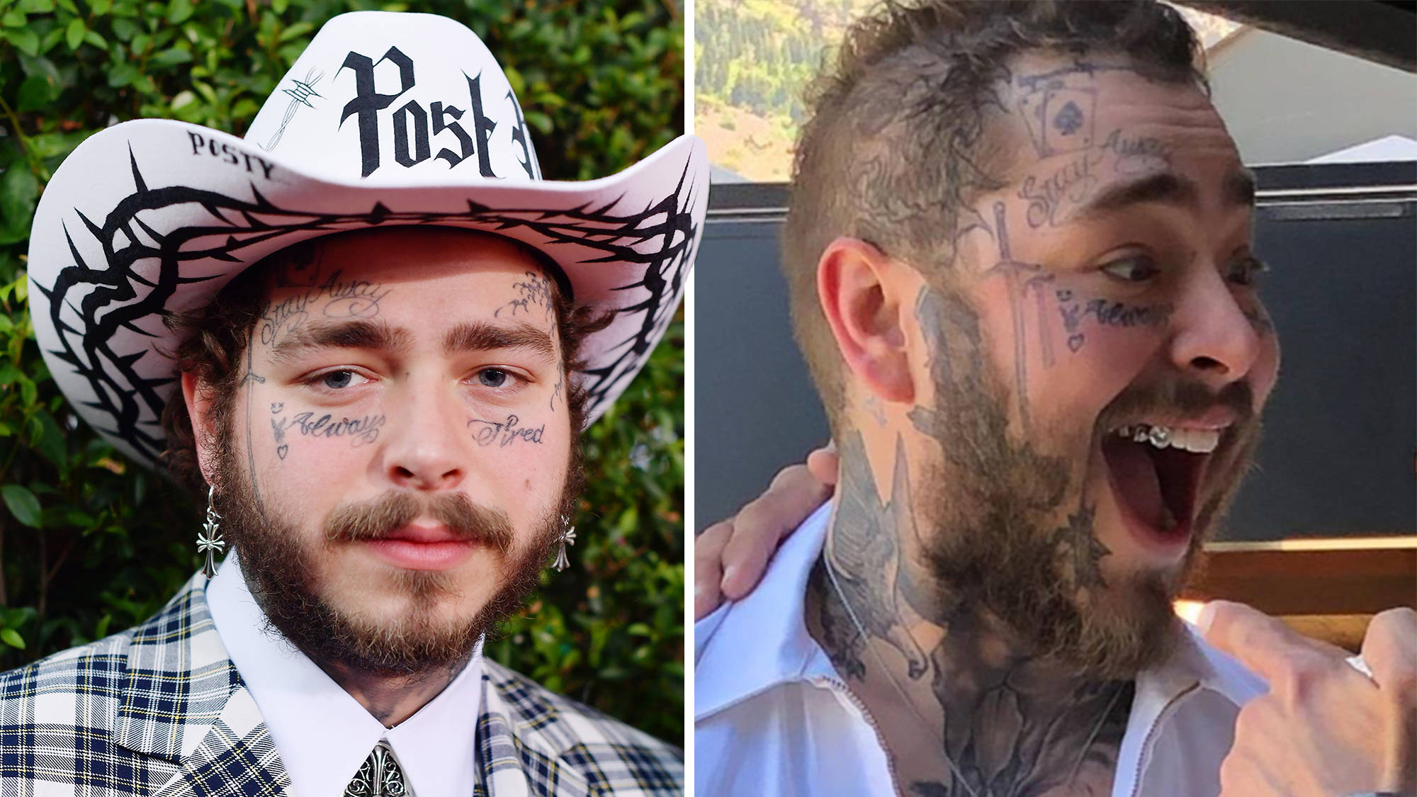 Post Malone Teeth: Before and After the Rappers Smile